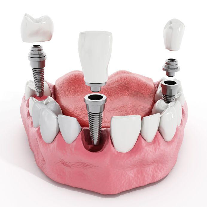 Modello di impianto dentale in titanio tra due denti